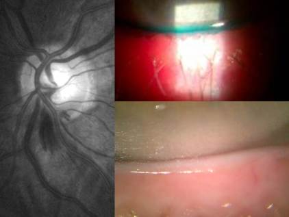 Glaucoma and the lid surface